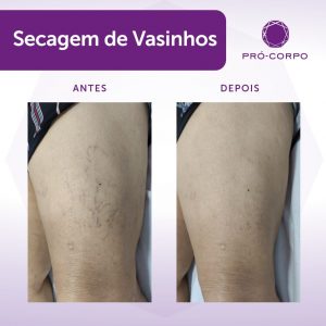 secagem de vasinhos