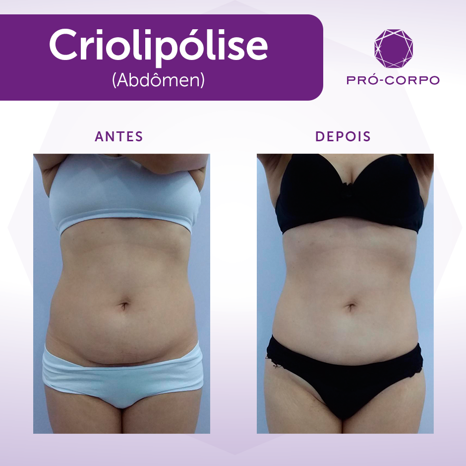 Criolipólise: Tratamento estético para gordura localizada