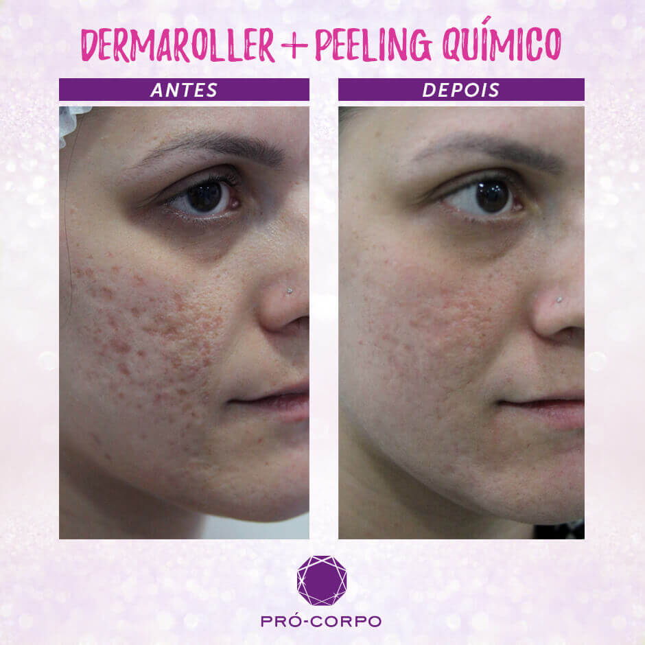 Dermaroller: Tratamento para cicatriz de acne | Pró-Corpo