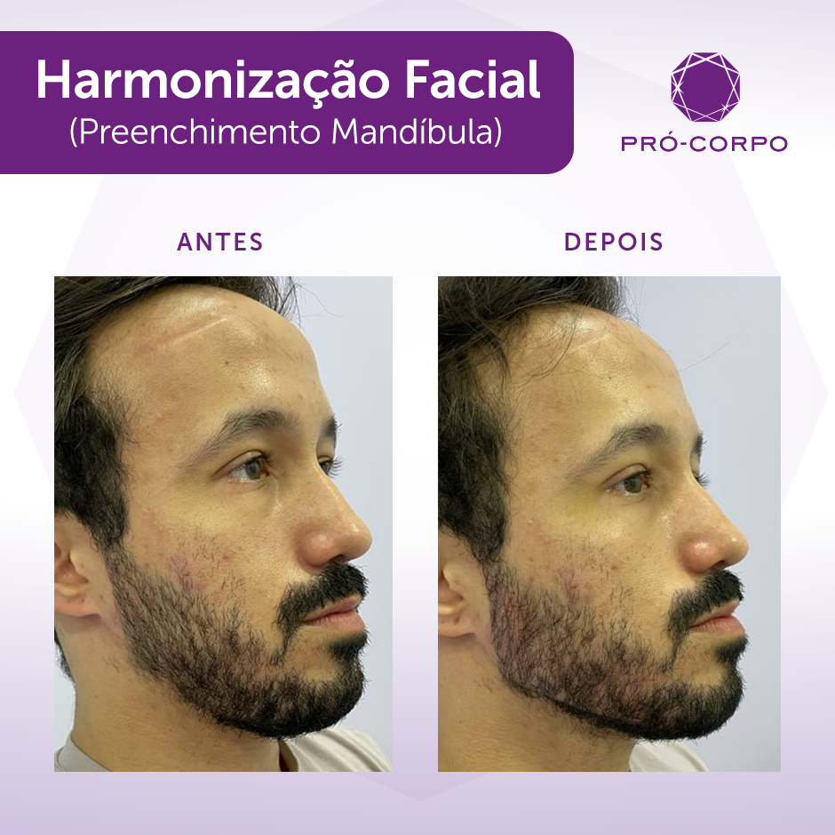 Harmonização Facial Masculina: Como é?
