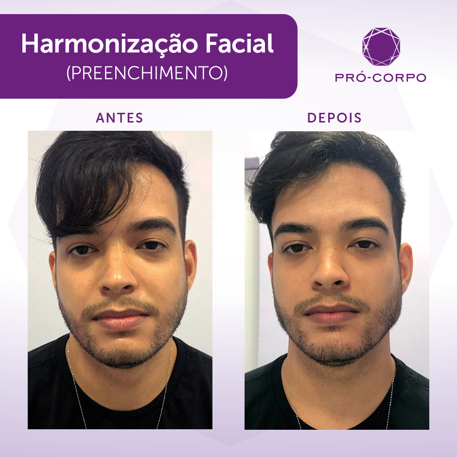 Harmonização facial masculina: Tudo que você precisa saber