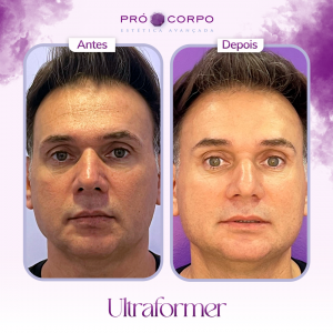 antes e depois ultraformer- ultraformer 3 - antes e depois