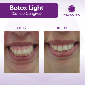 Botox ®: Fotos Antes e Depois sorriso gengival