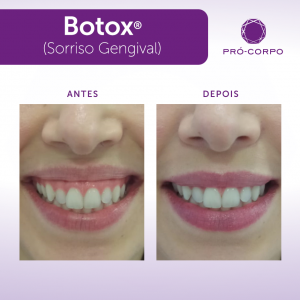 Botox ®: Fotos Antes e Depois sorriso gengival