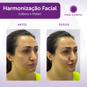 harm-antes-depois-labio-e-malar-