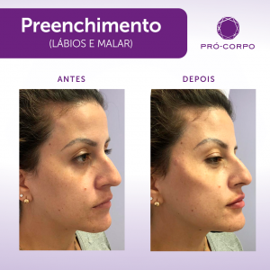 preench-labios-e-malar-santos2