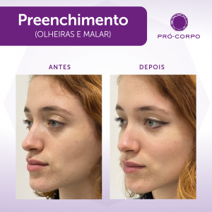 preench-olheira-e-malar-preenchimento